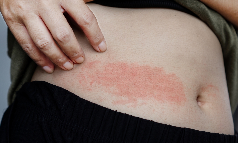 Šta znači kada veš "ne diše" i kako to utiče na vaše zdravlje 2 kožne reakcije